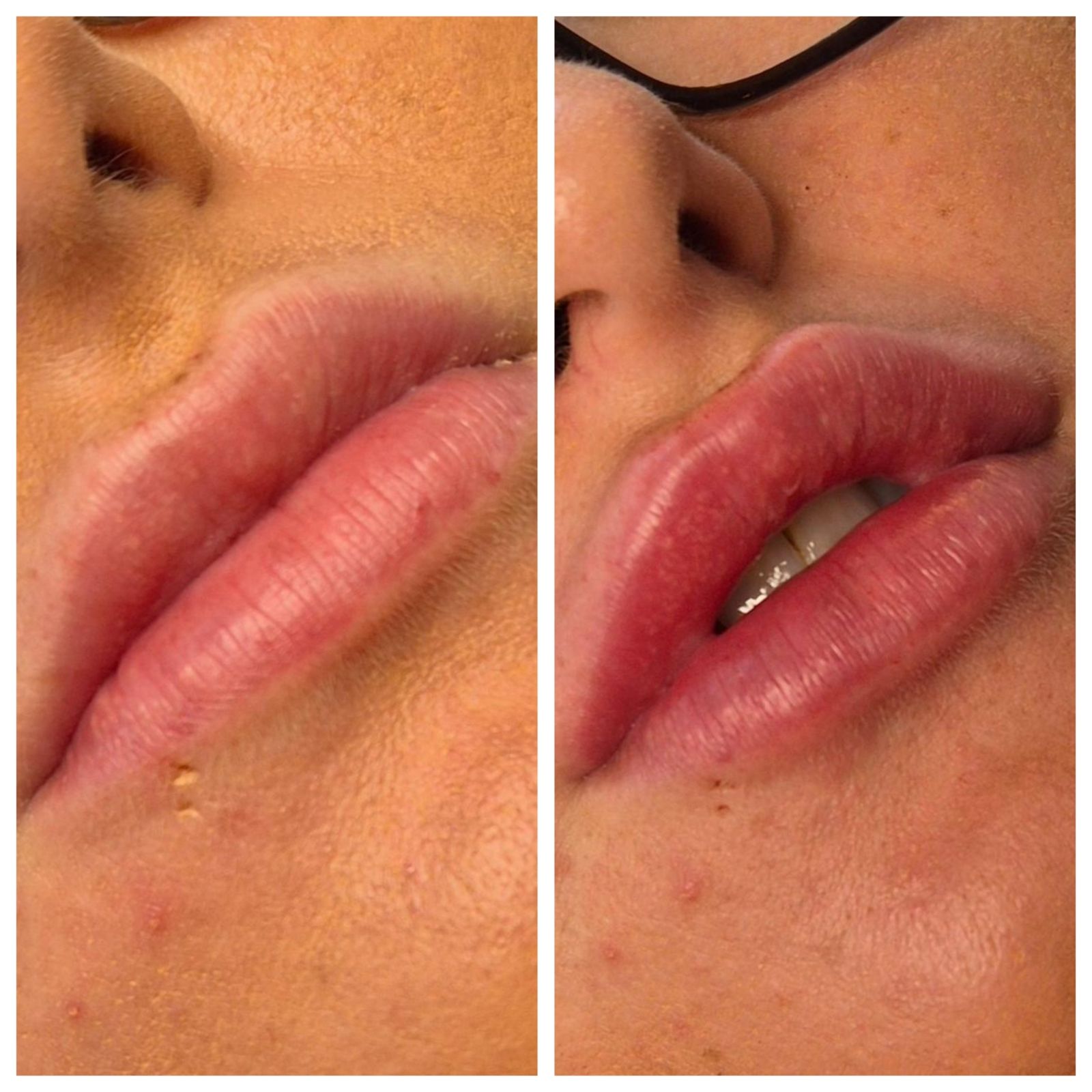 Anti-wrinkle injections